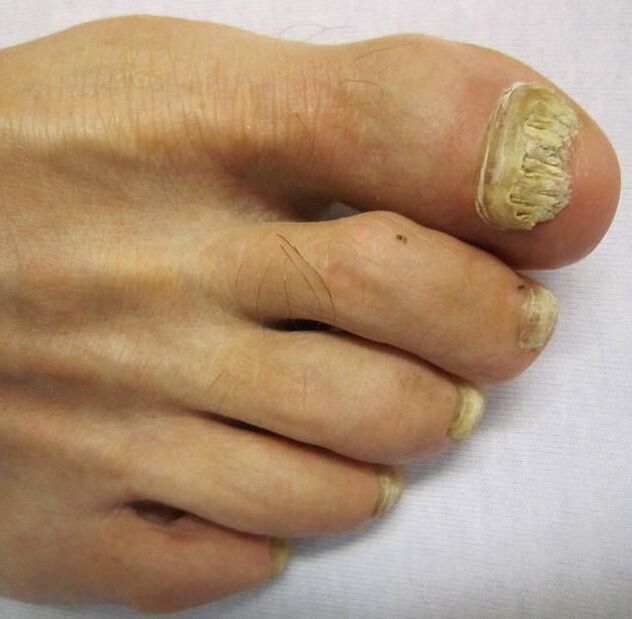 Damage to the nail plates