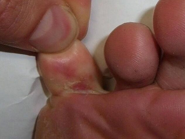 The effect of the fungus on the skin