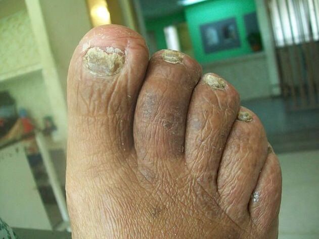 The lesion of the fungus