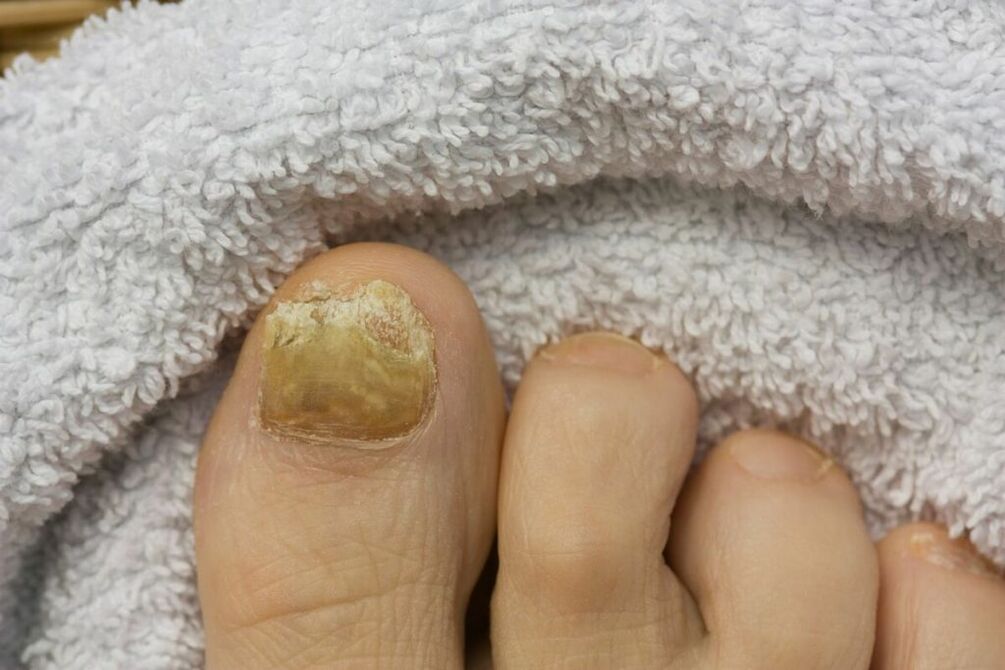 Atrophic stage of the fungus (falling off pieces of the toenail)