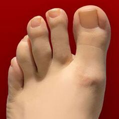 Nail fungus