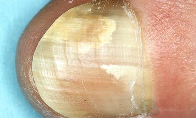Treatment of fingertips fungus with internal action drugs