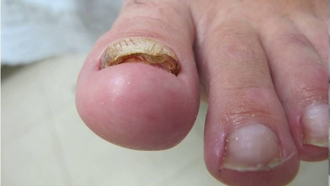 Hypertrophic fungus - edge deformation, loss of color and thickening of the nail plate